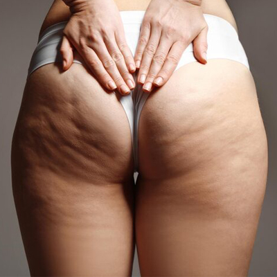 eliminar la celulitis