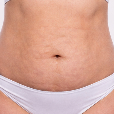 celulitis en abdomen
