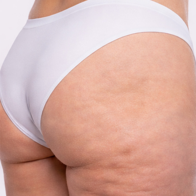 celulitis en glúteos