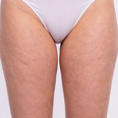 celulitis en piernas