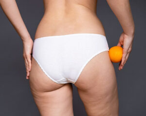 como eliminar celulitis