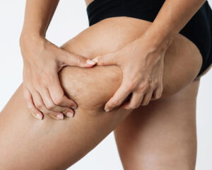 eliminar celulitis