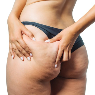 eliminar la celulitis