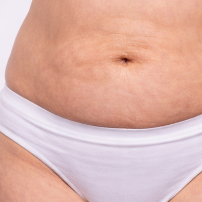 grasa localizada en abdomen y cintura