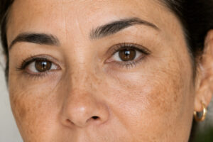 manchas solares