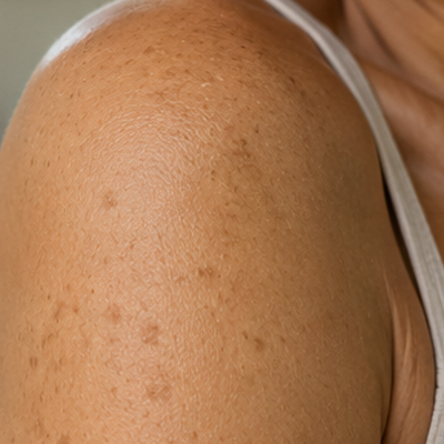 manchas solares en brazos