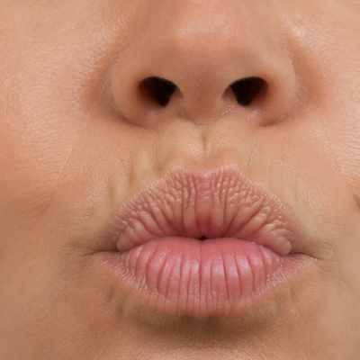 arrugas de expresión: labios
